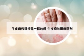 牛皮癣和湿疹是一样的吗 牛皮癣与湿疹区别