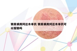 银屑病用阿达木单抗 银屑病用阿达木单抗可以报销吗