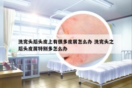 洗完头后头皮上有很多皮屑怎么办 洗完头之后头皮屑特别多怎么办