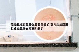 脂溢性皮炎是什么原因引起的 婴儿头皮脂溢性皮炎是什么原因引起的