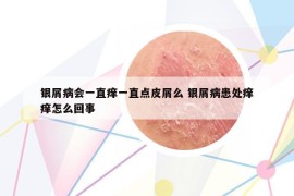 银屑病会一直痒一直点皮屑么 银屑病患处痒痒怎么回事