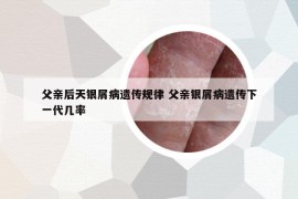 父亲后天银屑病遗传规律 父亲银屑病遗传下一代几率