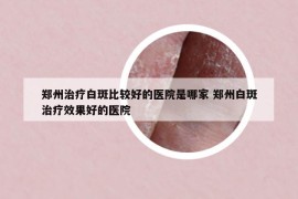 郑州治疗白斑比较好的医院是哪家 郑州白斑治疗效果好的医院