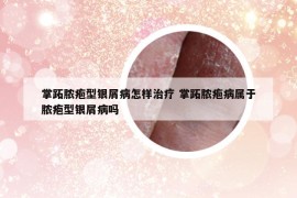 掌跖脓疱型银屑病怎样治疗 掌跖脓疱病属于脓疱型银屑病吗