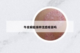 牛皮癣能接种流感疫苗吗