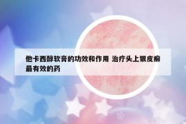 他卡西醇软膏的功效和作用 治疗头上银皮癣最有效的药