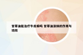甘草油能治疗牛皮癣吗 甘草油涂抹的作用与功效