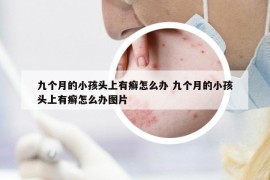 九个月的小孩头上有癣怎么办 九个月的小孩头上有癣怎么办图片