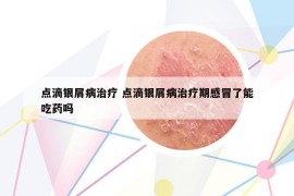 点滴银屑病治疗 点滴银屑病治疗期感冒了能吃药吗