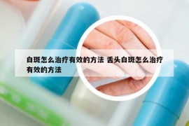 白斑怎么治疗有效的方法 舌头白斑怎么治疗有效的方法