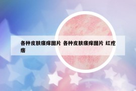各种皮肤瘙痒图片 各种皮肤瘙痒图片 红疙瘩