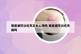 银屑病可以吃天王补心液吗 银屑病可以吃天麻吗