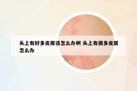 头上有好多皮屑该怎么办啊 头上有很多皮屑怎么办