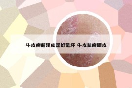 牛皮癣起硬皮是好是坏 牛皮肤癣硬皮