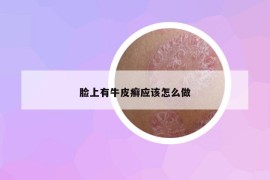 脸上有牛皮癣应该怎么做