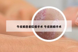 牛皮癣患者肛瘘手术 牛皮肤癣手术