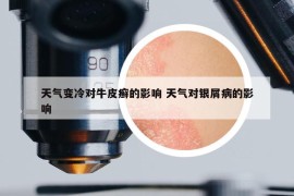 天气变冷对牛皮癣的影响 天气对银屑病的影响