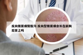 反向银屑病臀股沟 反向型银屑病会长在前胸后背上吗