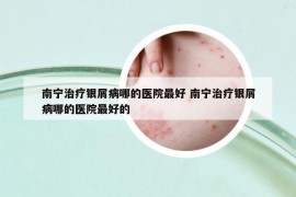 南宁治疗银屑病哪的医院最好 南宁治疗银屑病哪的医院最好的