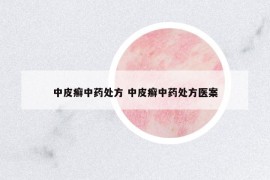 中皮癣中药处方 中皮癣中药处方医案