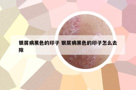 银屑病黑色的印子 银屑病黑色的印子怎么去除
