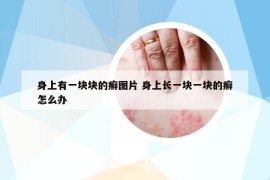 身上有一块块的癣图片 身上长一块一块的癣怎么办