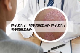 脖子上长了一块牛皮癣怎么办 脖子上长了一块牛皮癣怎么办