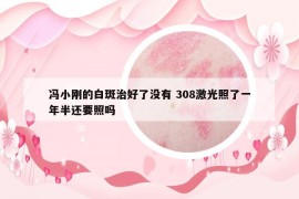 冯小刚的白斑治好了没有 308激光照了一年半还要照吗