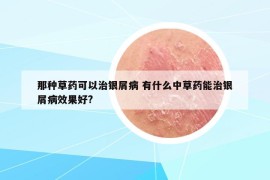 那种草药可以治银屑病 有什么中草药能治银屑病效果好?