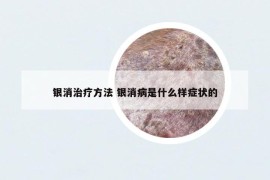 银消治疗方法 银消病是什么样症状的