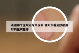 洛阳哪个医院治疗牛皮癣 洛阳市看皮肤病最好的医院在哪