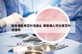 银屑病能用艾叶泡澡么 银屑病人可以用艾叶泡澡吗