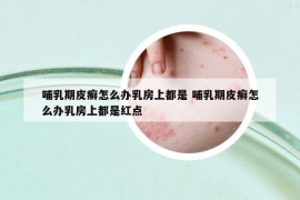 哺乳期皮癣怎么办乳房上都是 哺乳期皮癣怎么办乳房上都是红点