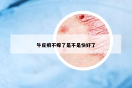 牛皮癣不痒了是不是快好了