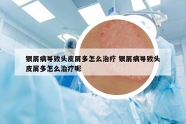 银屑病导致头皮屑多怎么治疗 银屑病导致头皮屑多怎么治疗呢