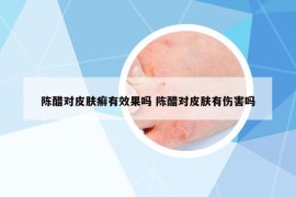 陈醋对皮肤癣有效果吗 陈醋对皮肤有伤害吗