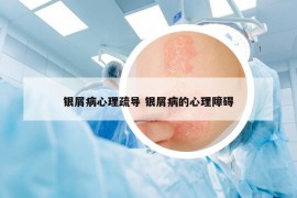 银屑病心理疏导 银屑病的心理障碍