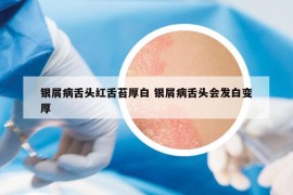 银屑病舌头红舌苔厚白 银屑病舌头会发白变厚