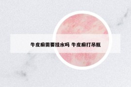 牛皮癣需要挂水吗 牛皮癣打吊瓶