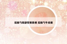 后脑勺局部性银屑病 后脑勺牛皮廨