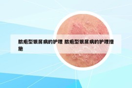 脓疱型银屑病的护理 脓疱型银屑病的护理措施