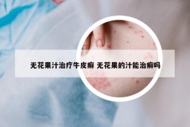 无花果汁治疗牛皮癣 无花果的汁能治癣吗