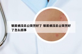 银屑病没忌口突然好了 银屑病没忌口突然好了怎么回事