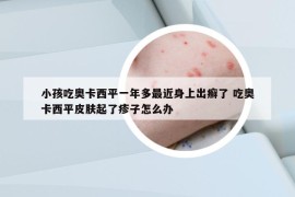 小孩吃奥卡西平一年多最近身上出癣了 吃奥卡西平皮肤起了疹子怎么办