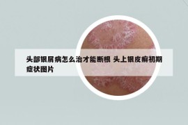 头部银屑病怎么治才能断根 头上银皮癣初期症状图片