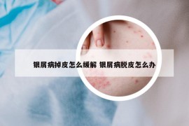银屑病掉皮怎么缓解 银屑病脱皮怎么办