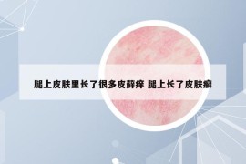 腿上皮肤里长了很多皮藓痒 腿上长了皮肤癣
