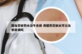 醋加花椒熬水治牛皮癣 用醋熬花椒水可以治银屑病吗