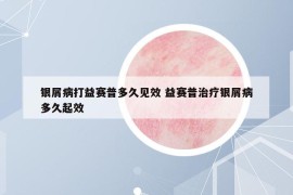 银屑病打益赛普多久见效 益赛普治疗银屑病多久起效