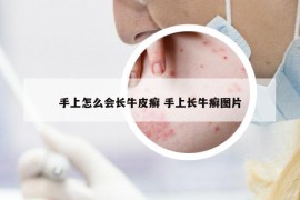 手上怎么会长牛皮癣 手上长牛癣图片